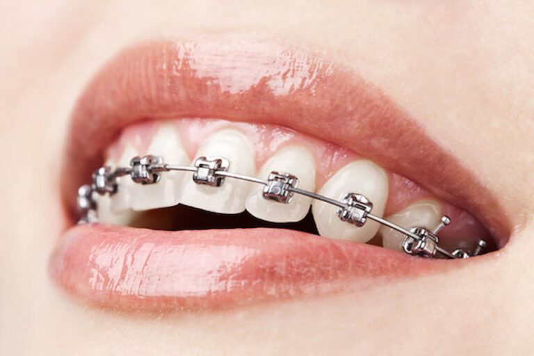 braces amp